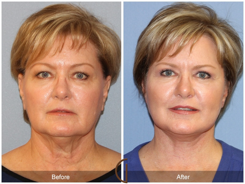 Natural Lift 415 Image