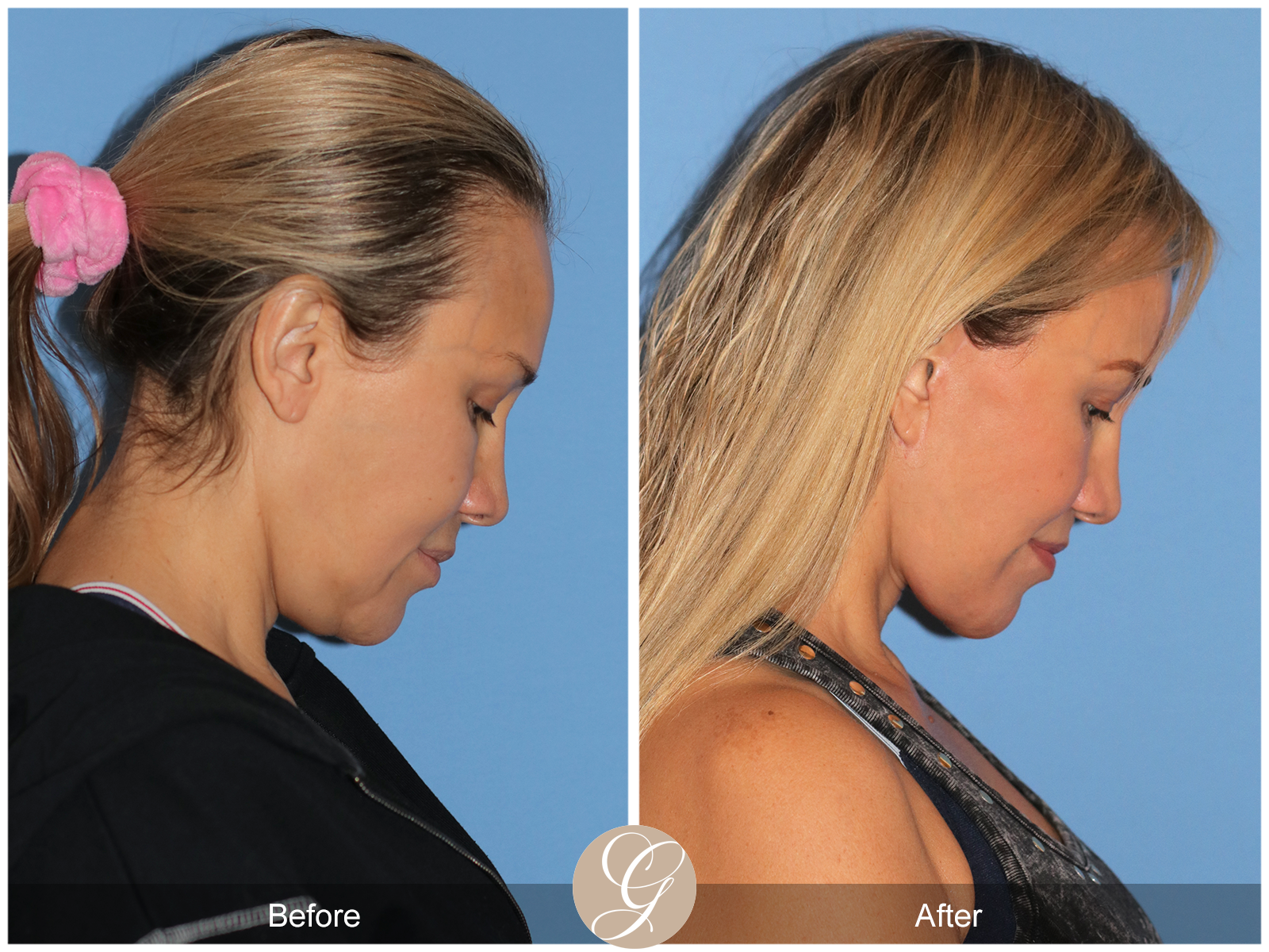 Preservation Facelift Case 18 Image