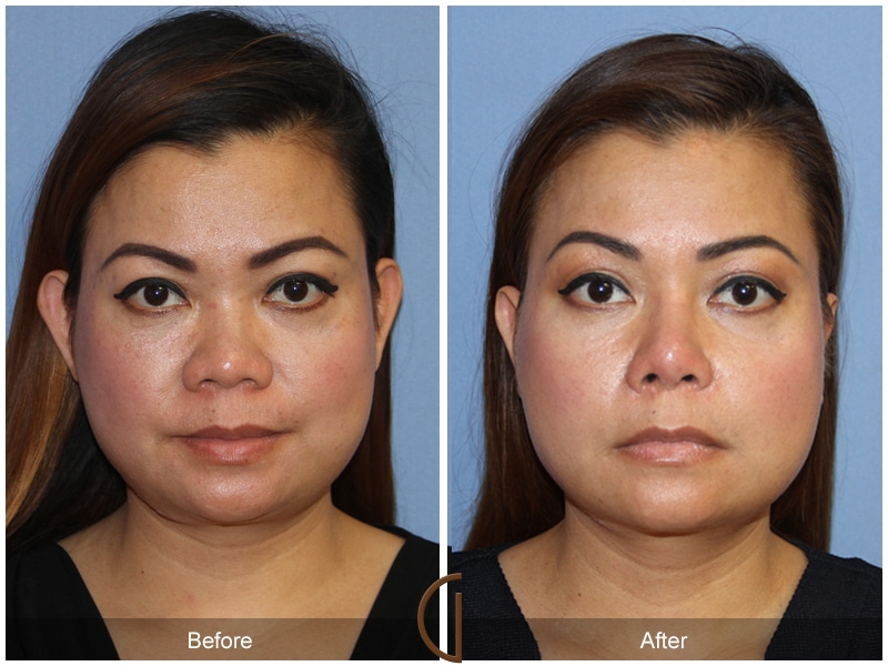 Rhinoplasty 103 Image