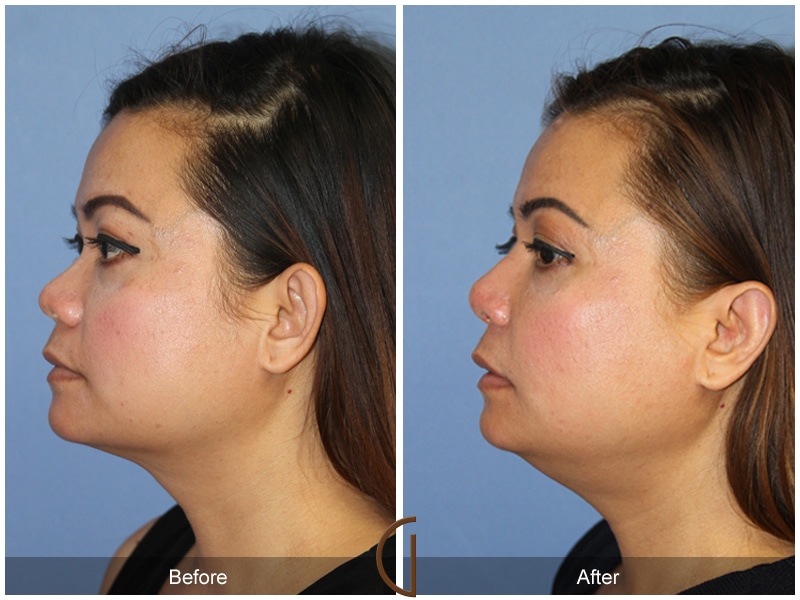 Rhinoplasty 103 Image