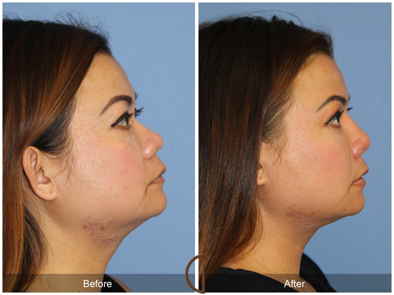 Rhinoplasty 103 Image