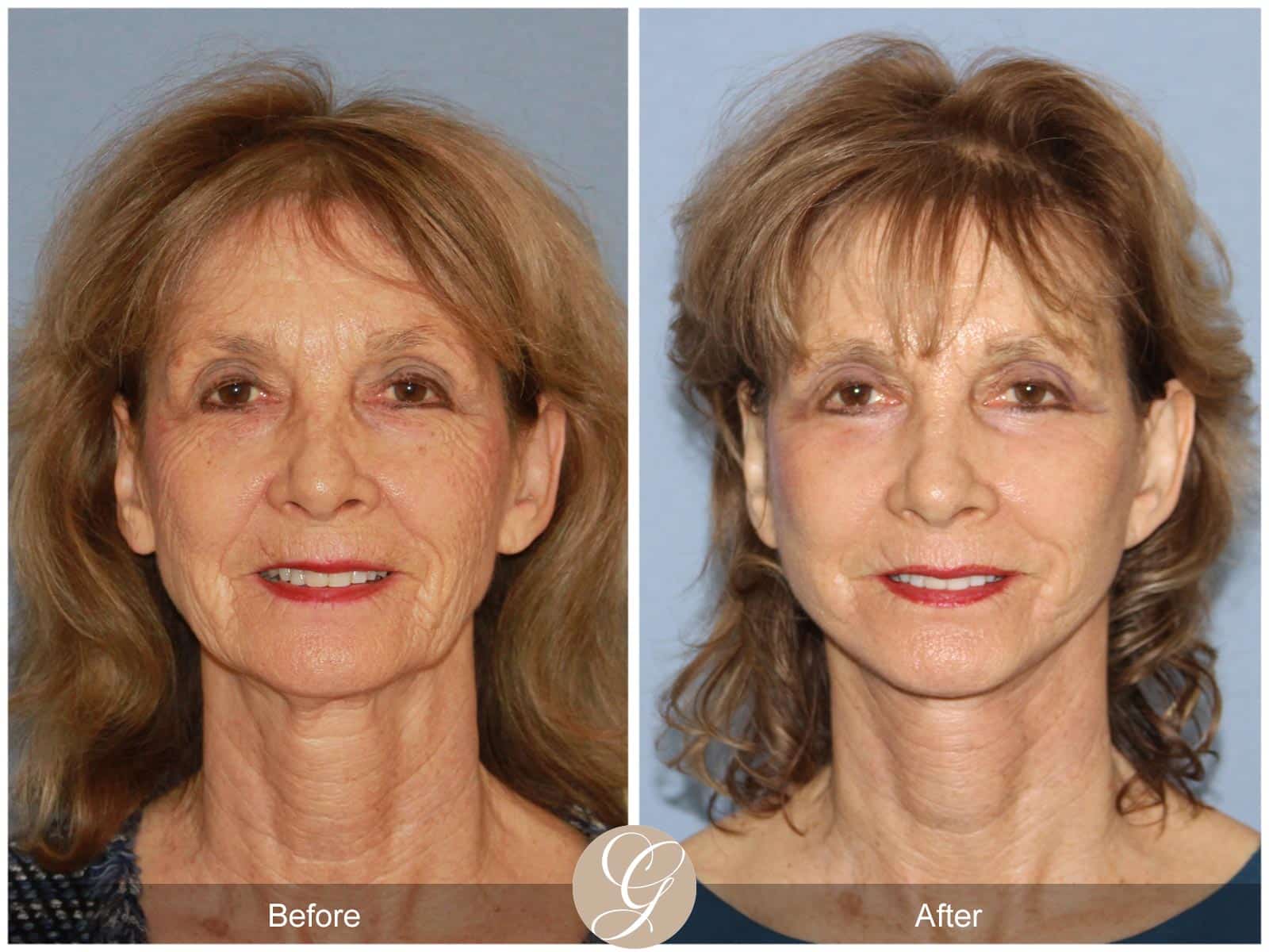 Eyelid Lift and Neck Lift 100 Image