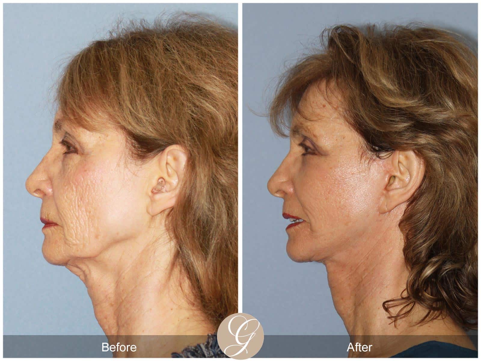 Eyelid Lift and Neck Lift 100 Image