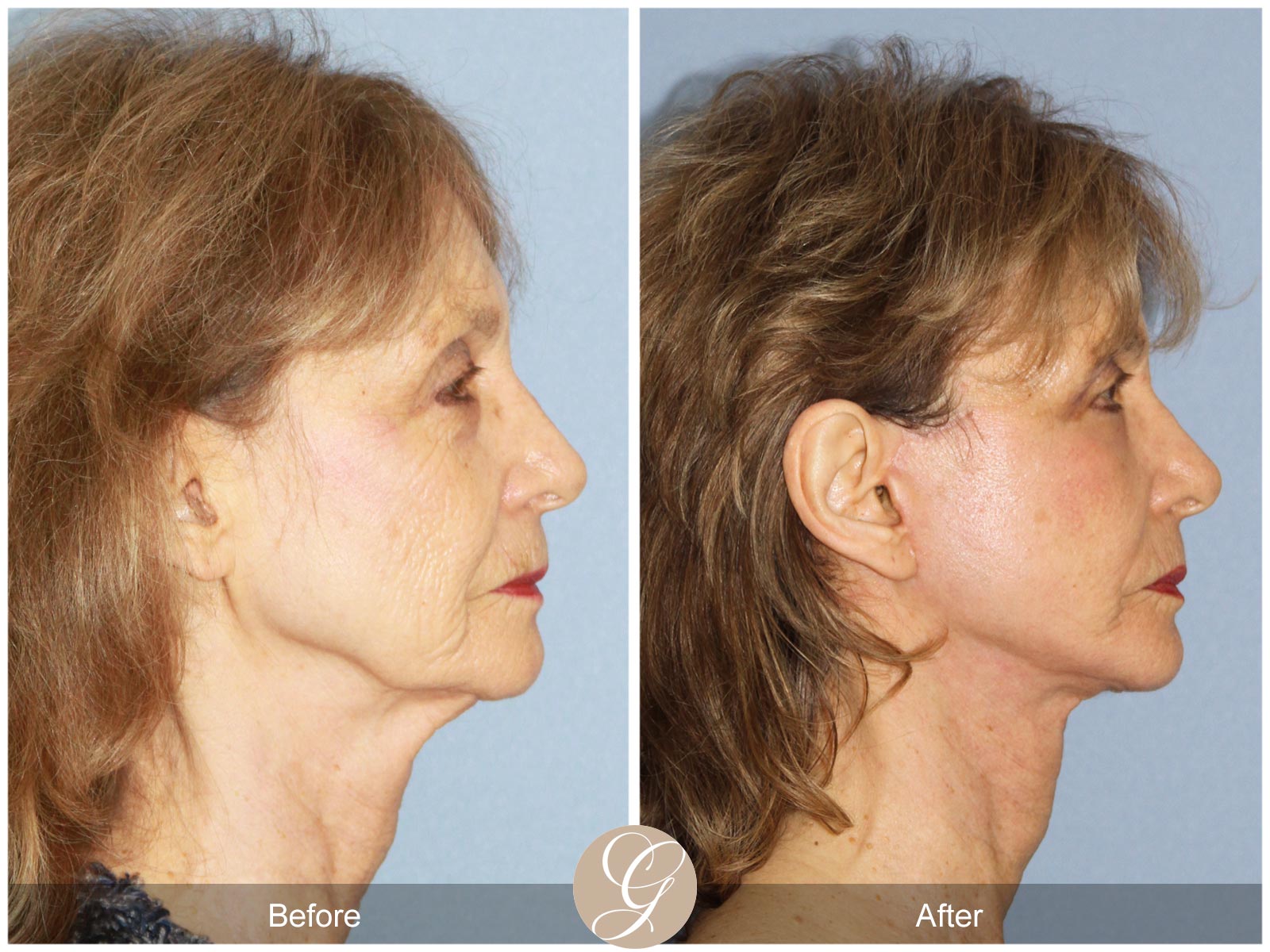 Eyelid Lift and Neck Lift 100 Image