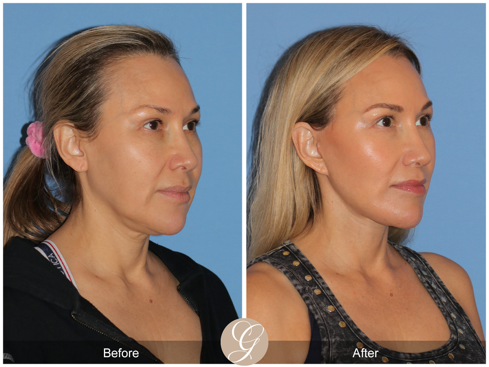 Preservation Facelift Case 18 Image