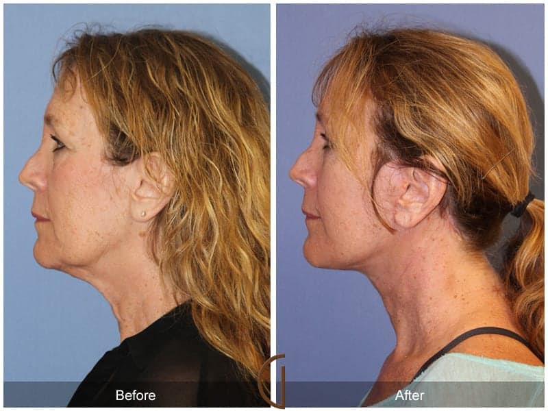 Facelift Surgery Los Angeles Image