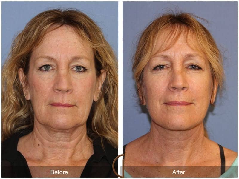 Facelift Surgery Los Angeles Image