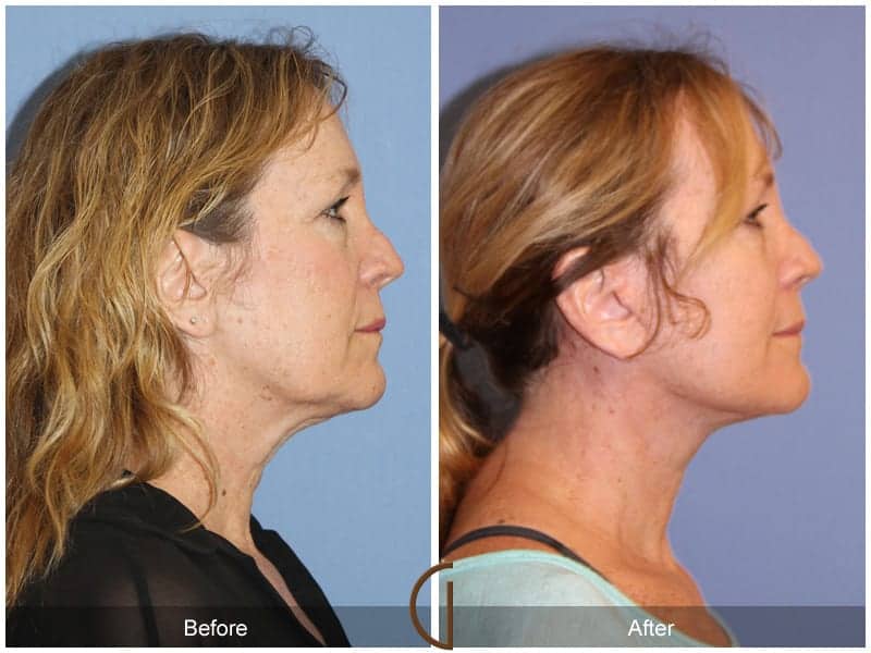 Facelift Surgery Los Angeles Image