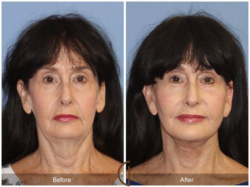 Facelift Surgery San Diego Image