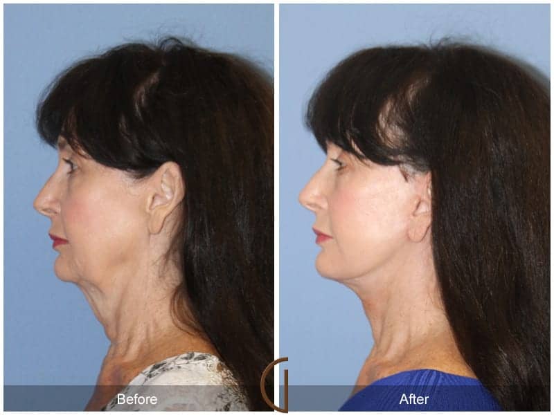 Facelift Surgery San Diego Image