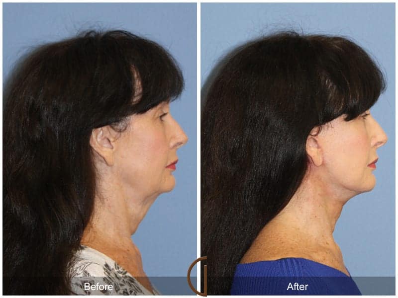 Facelift Surgery San Diego Image