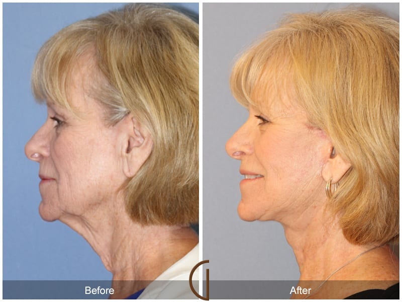Facelift Surgery Santa Ana Image