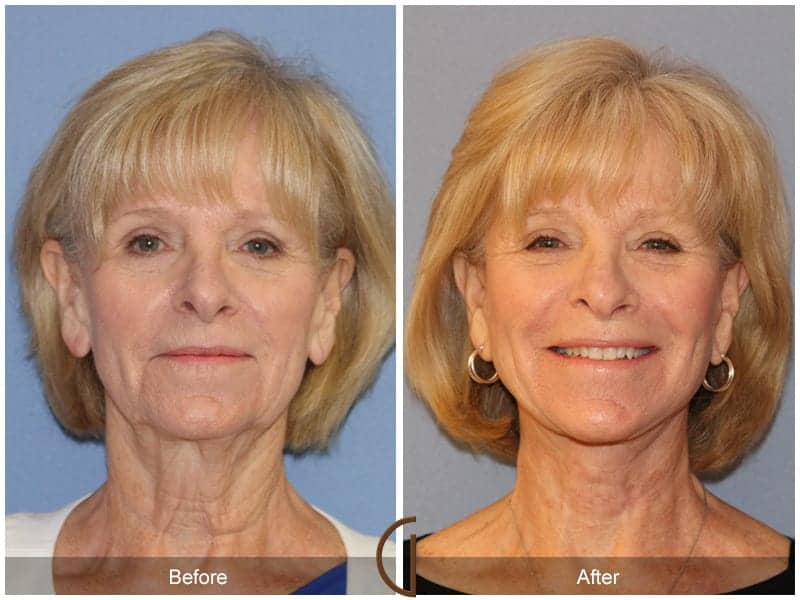 Facelift Surgery Santa Ana Image