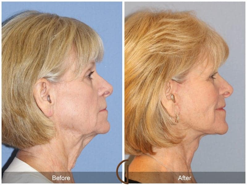 Facelift Surgery Santa Ana Image