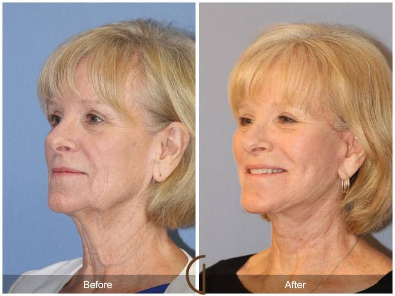 Facelift Surgery Santa Ana Image