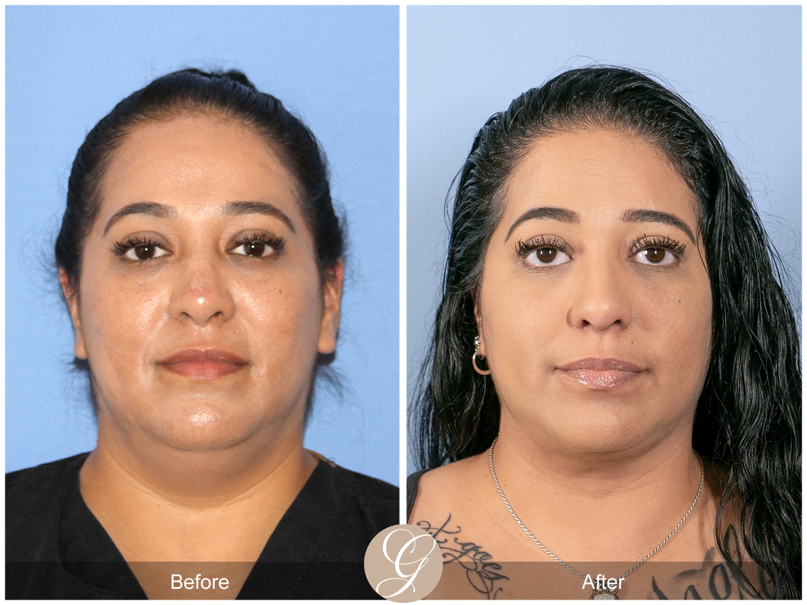 Neck Liposuction Orange County Case 1 Image
