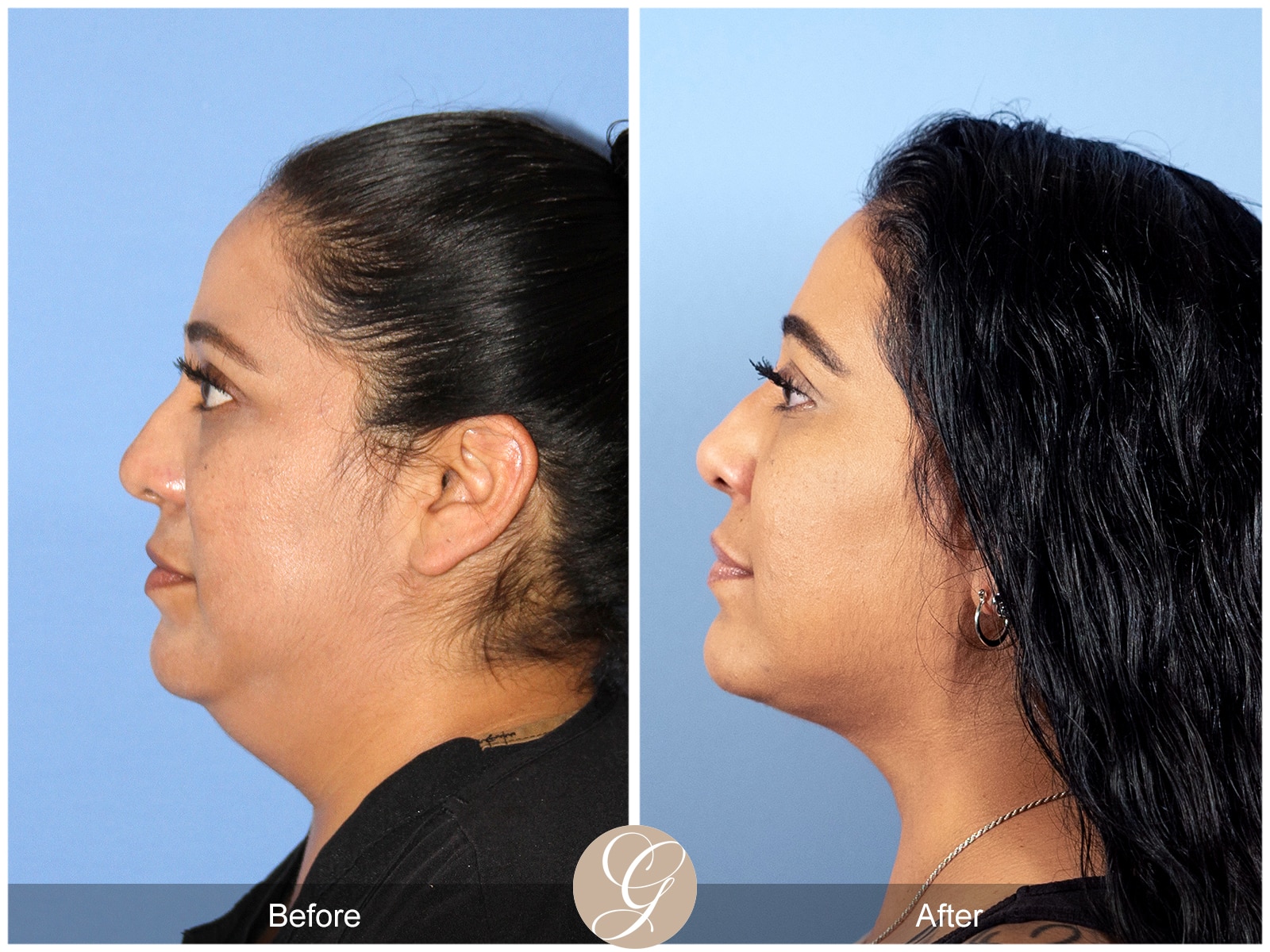 Neck Liposuction Orange County Case 1 Image