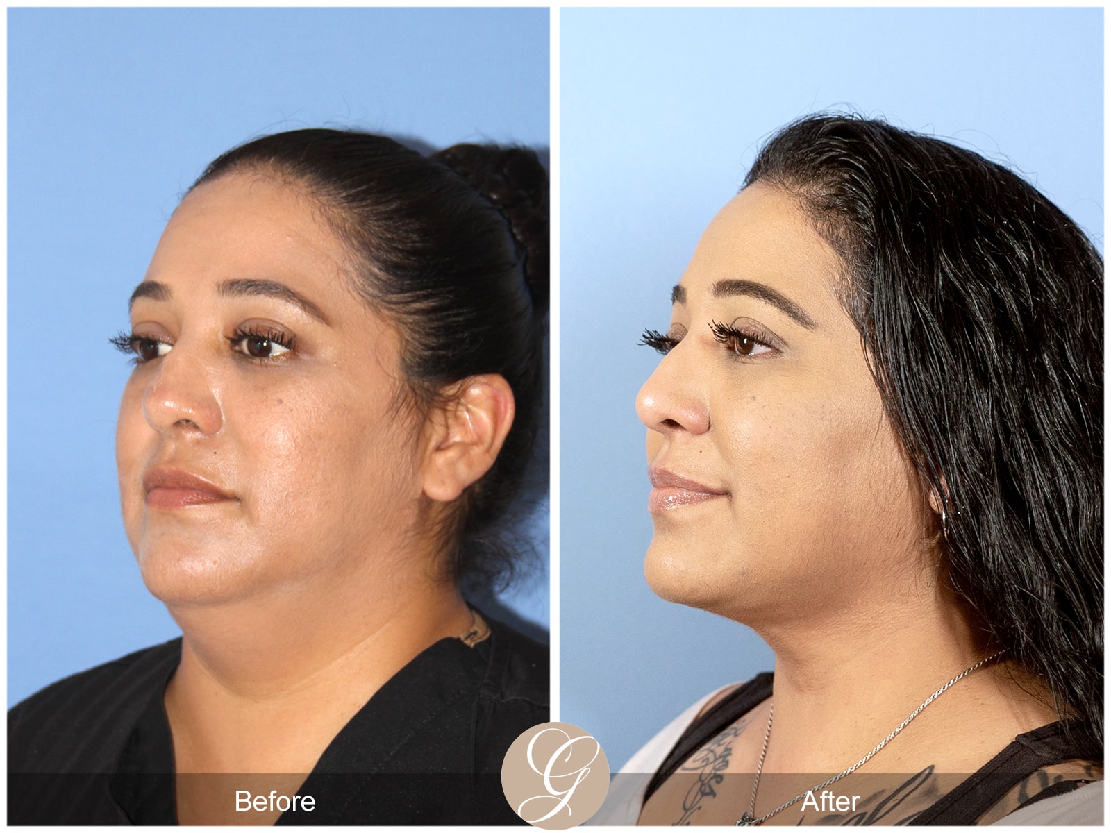 Neck Liposuction Orange County Case 1 Image