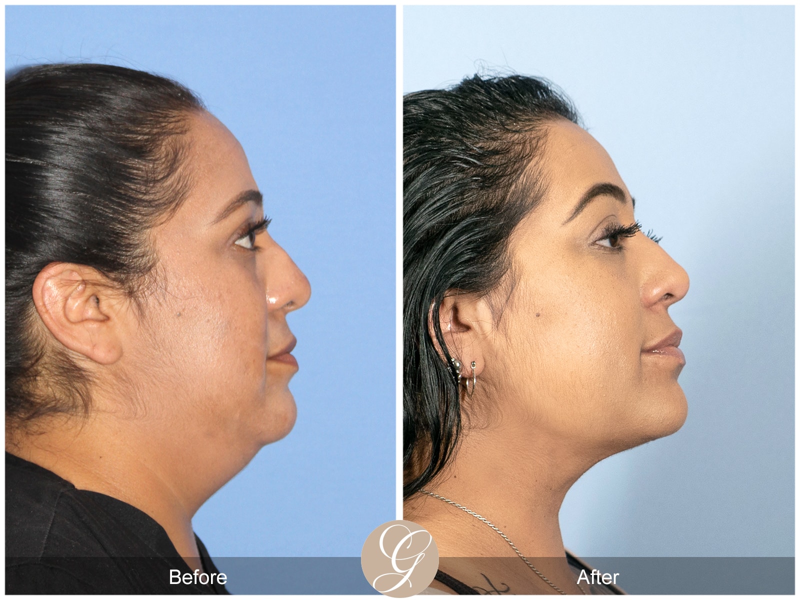 Neck Liposuction Orange County Case 1 Image