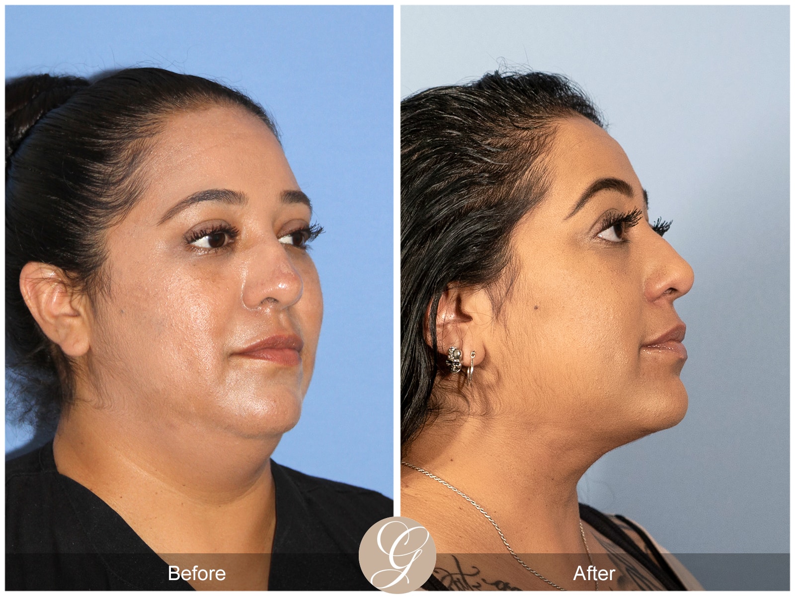 Neck Liposuction Orange County Case 1 Image