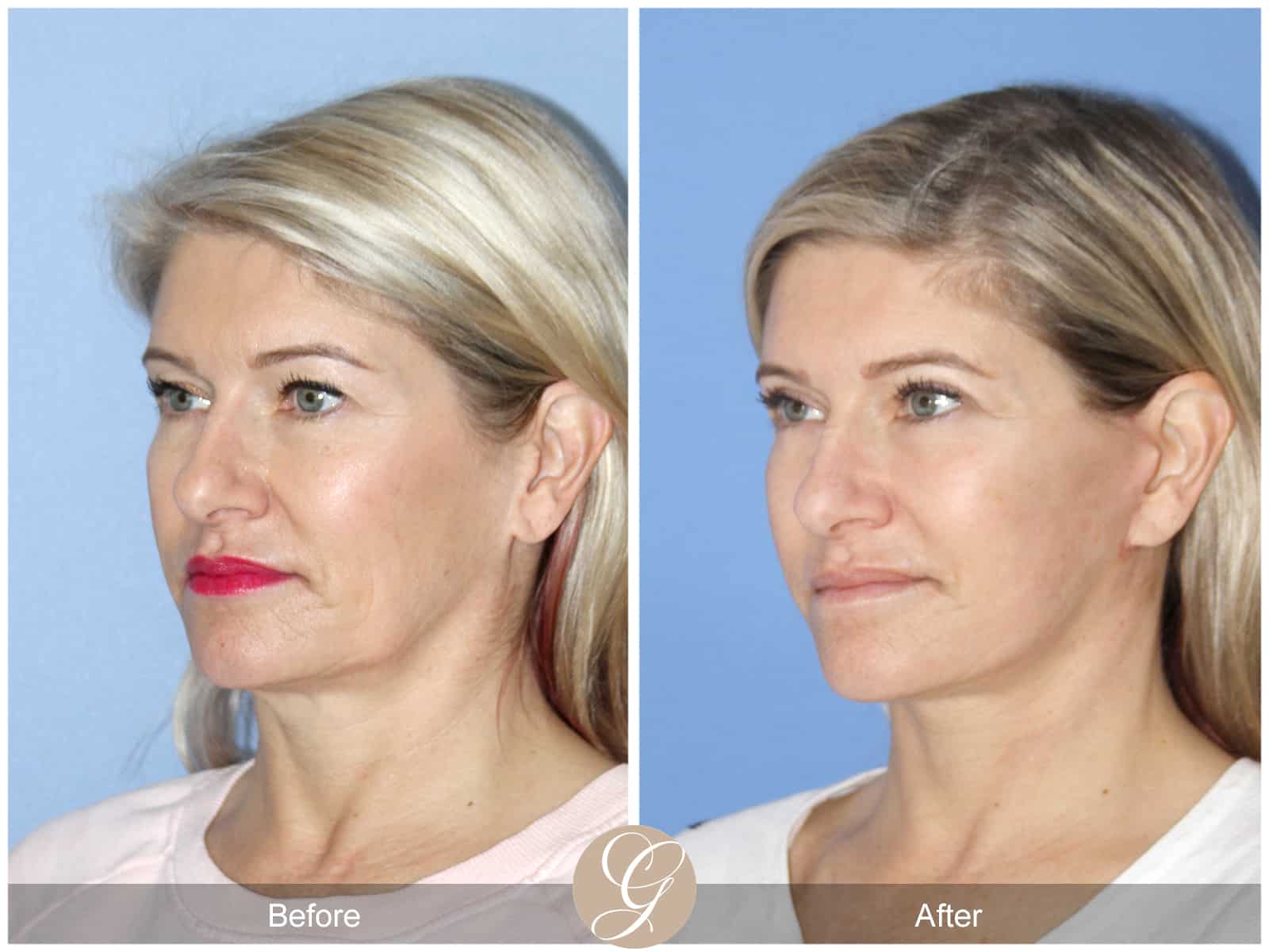 Natural Lift- 414 Image