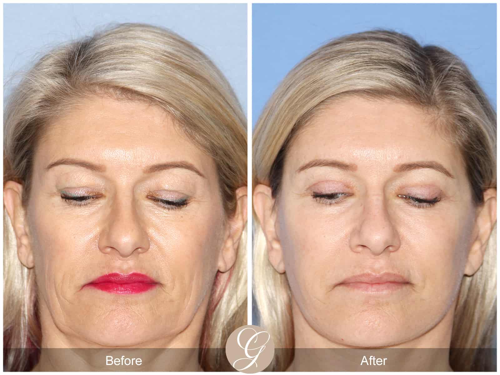 Natural Lift- 414 Image