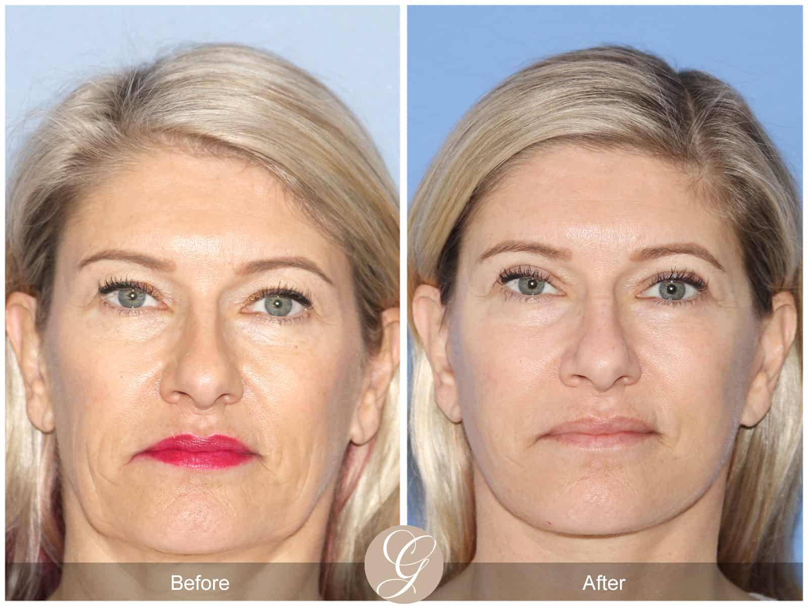 Natural Lift- 414 Image