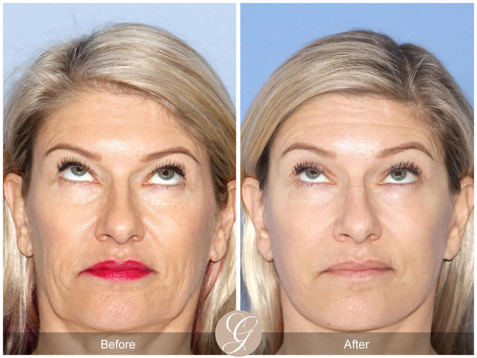 Natural Lift- 414 Image