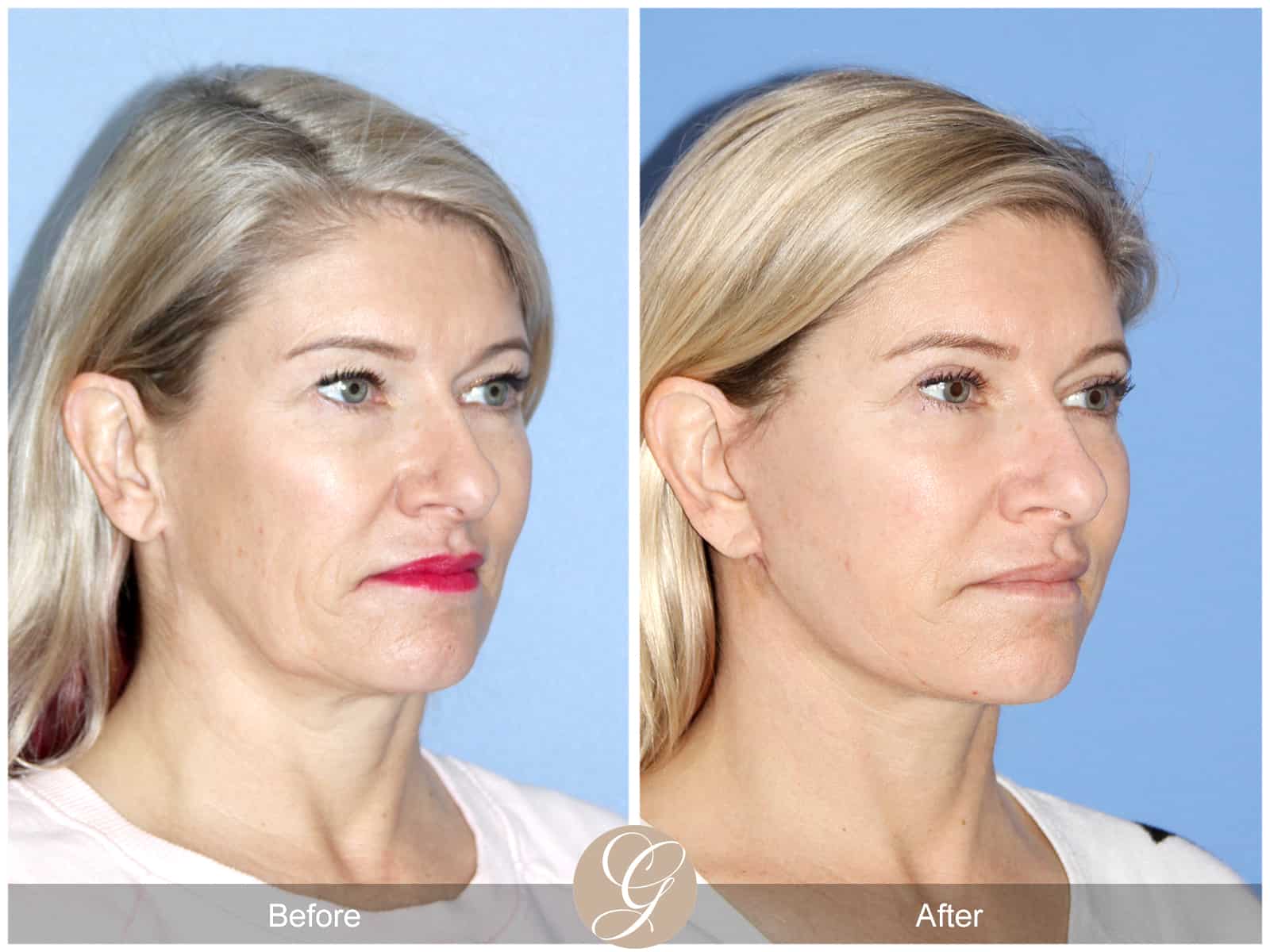 Natural Lift- 414 Image