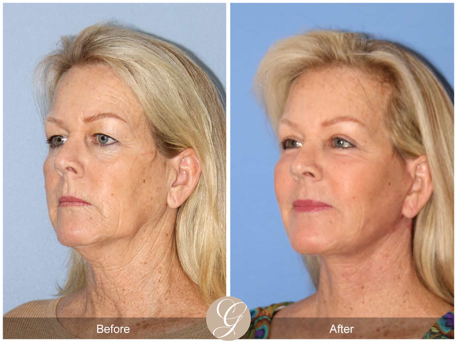 Natural Lift- 406 Image