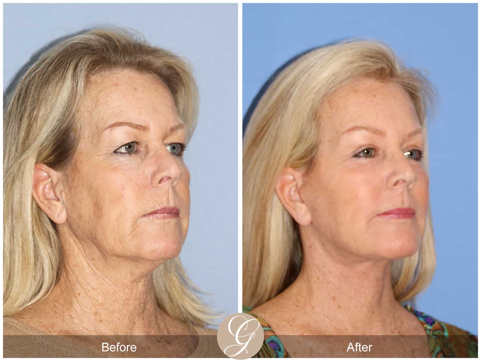 Natural Lift- 406 Image