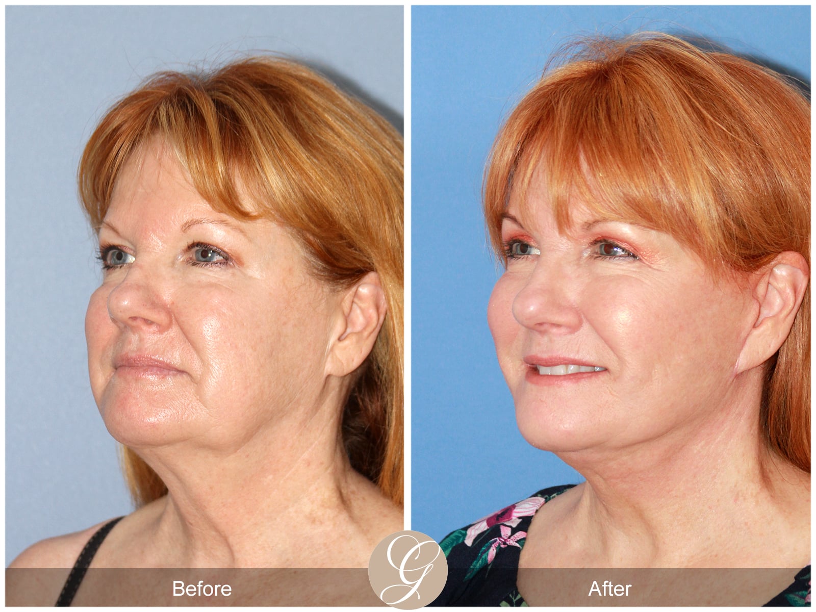 Natural-Eye Lift- 407 Image