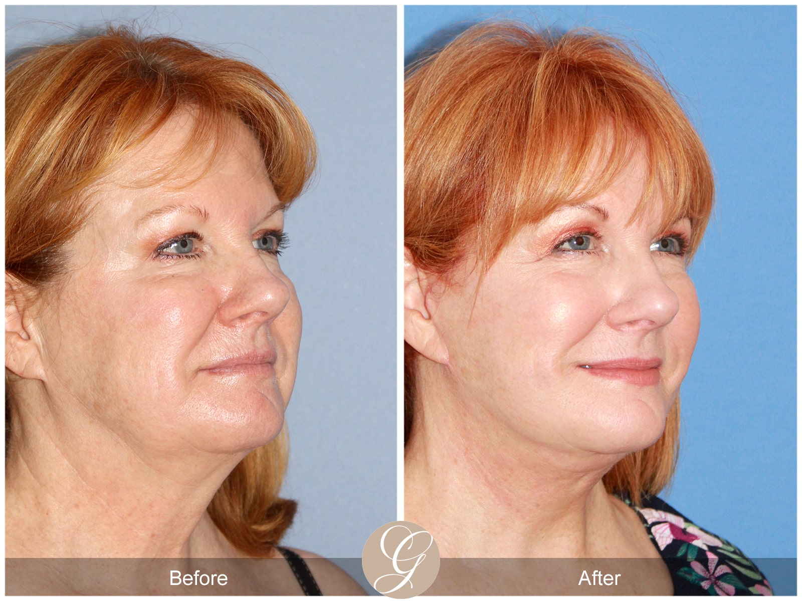 Natural-Eye Lift- 407 Image