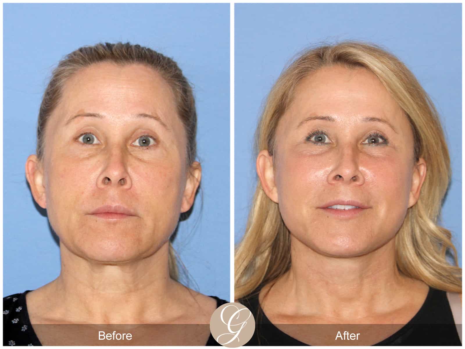 Neck Lift- 488 Image