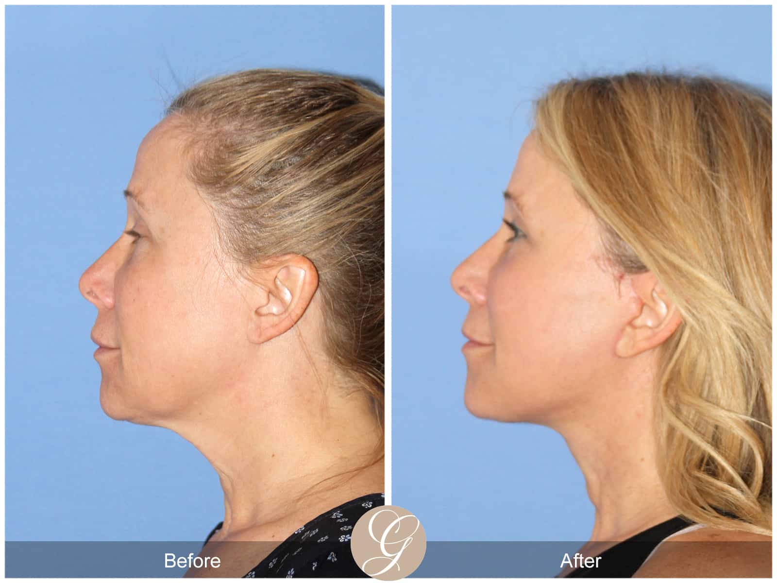 Neck Lift- 488 Image