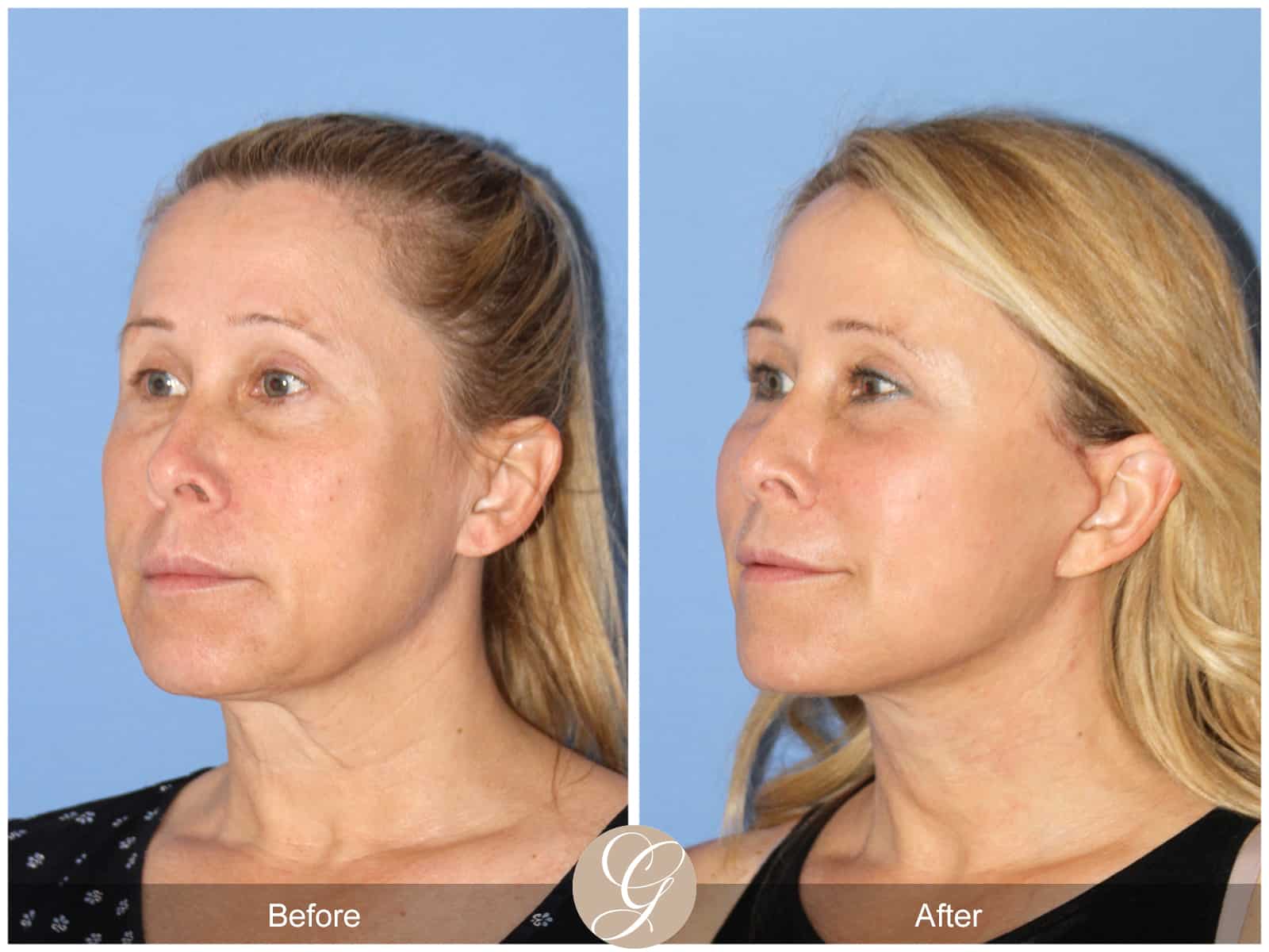 Neck Lift- 488 Image