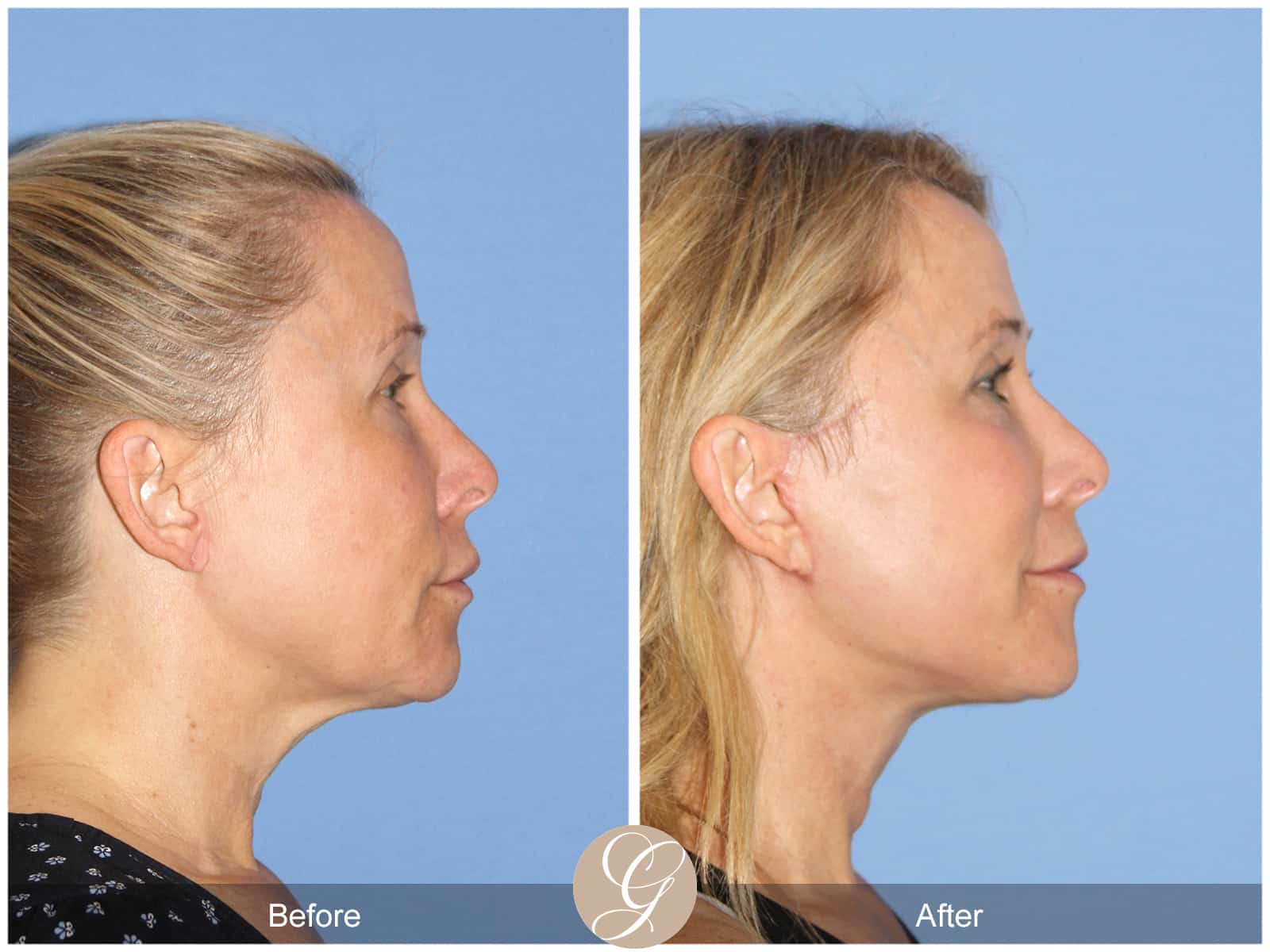 Neck Lift- 488 Image