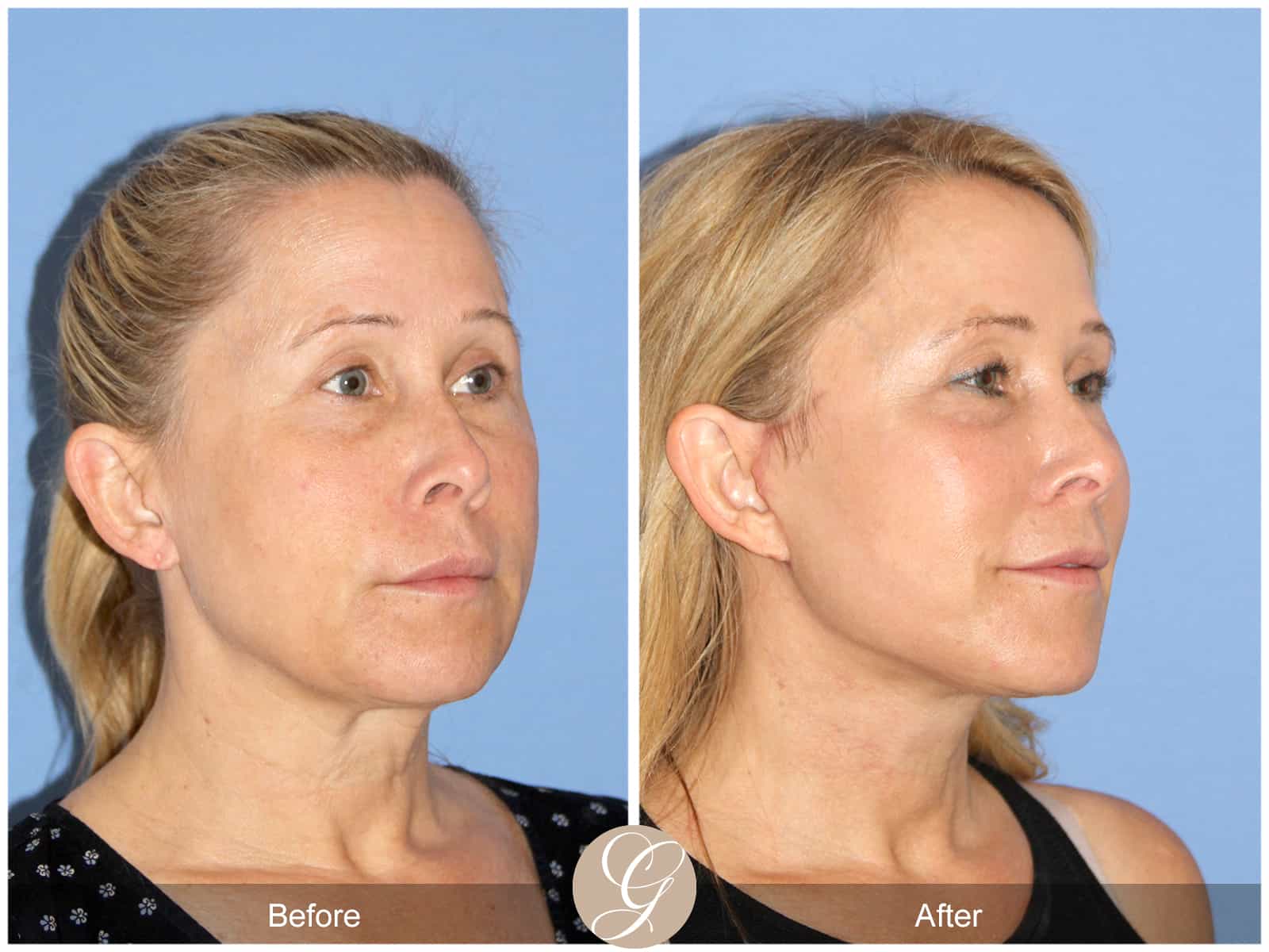 Neck Lift- 488 Image