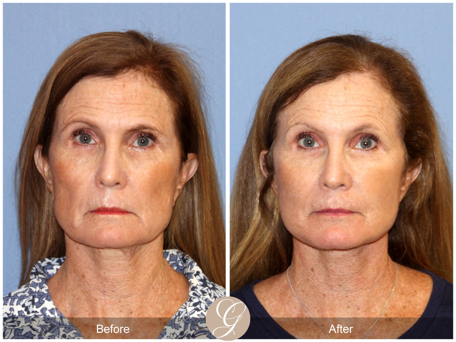 Natural Lift 420 Image