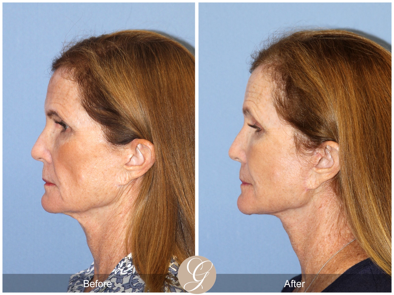 Natural Lift 420 Image