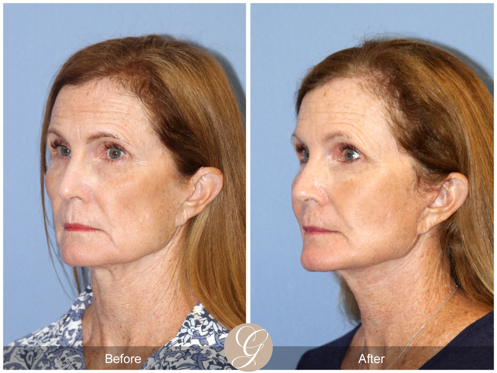 Natural Lift 420 Image