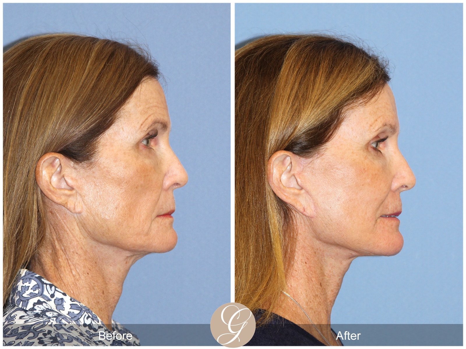 Natural Lift 420 Image