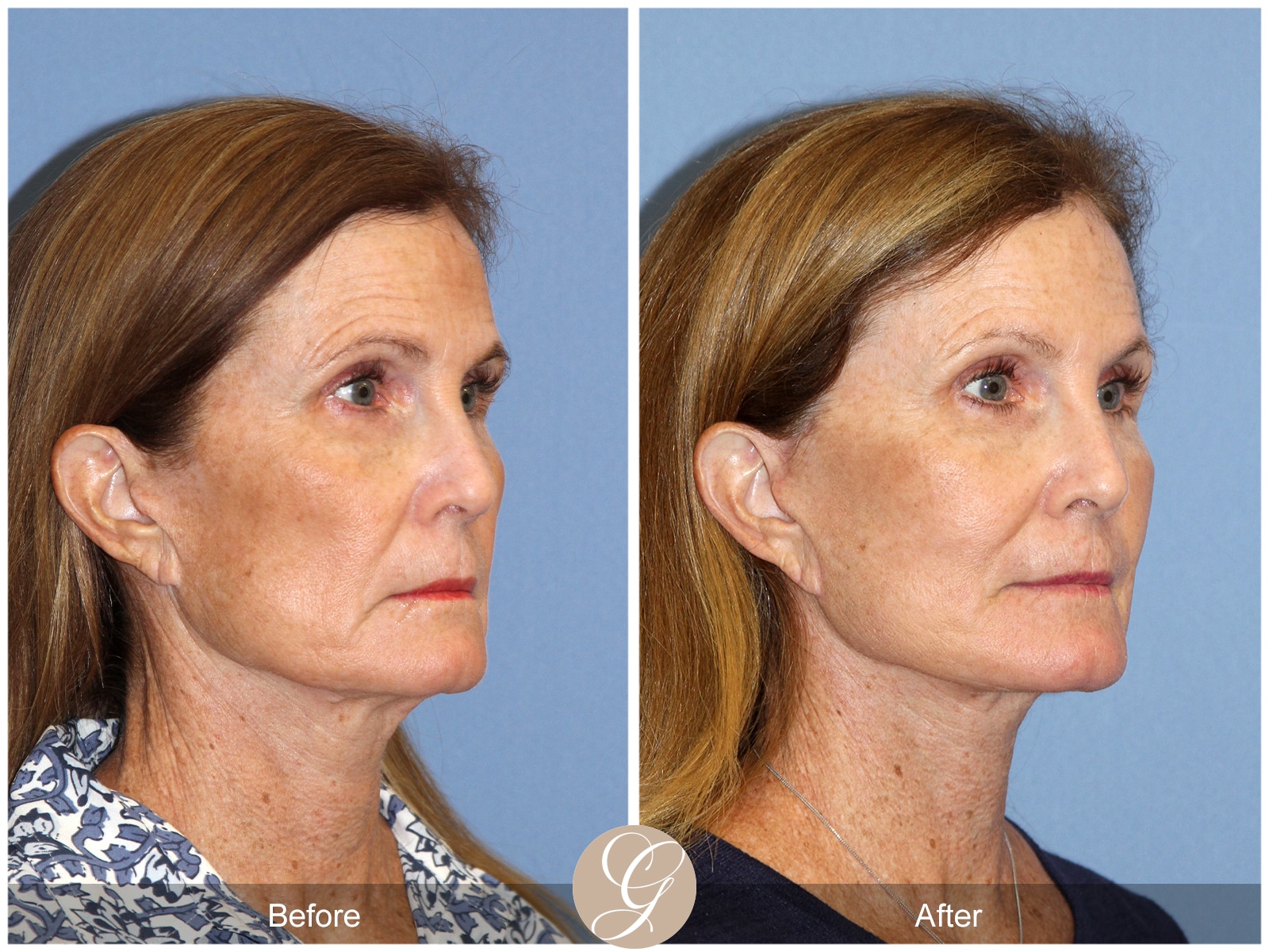 Natural Lift 420 Image