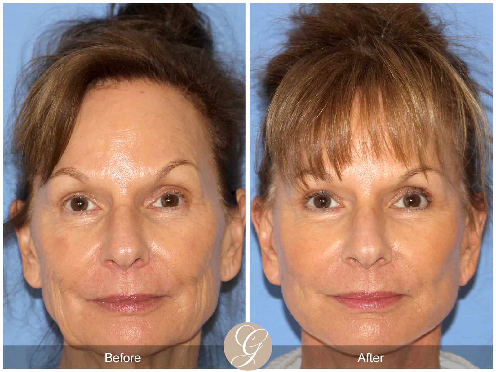 Neck Lift- 411 Image
