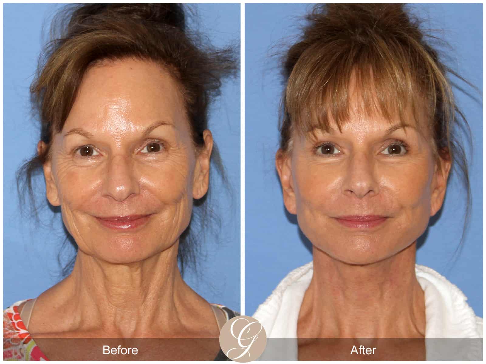 Neck Lift- 411 Image
