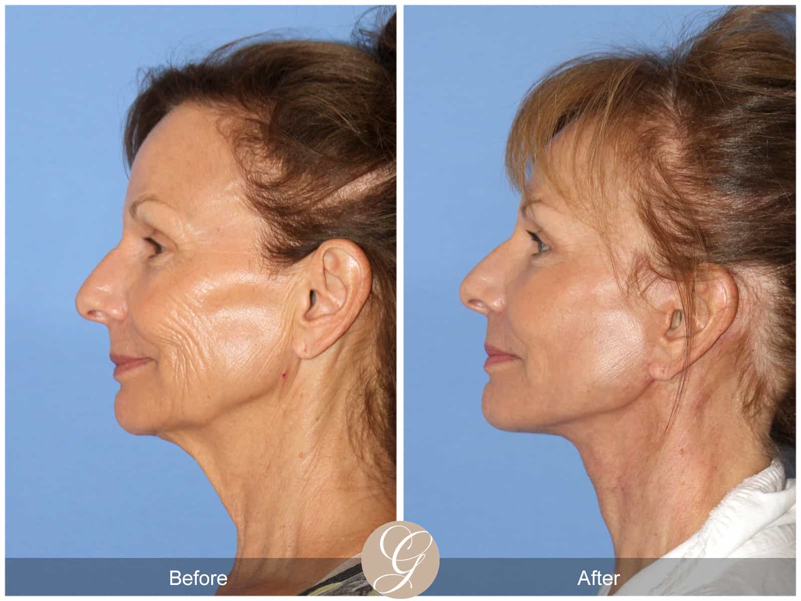 Neck Lift- 411 Image