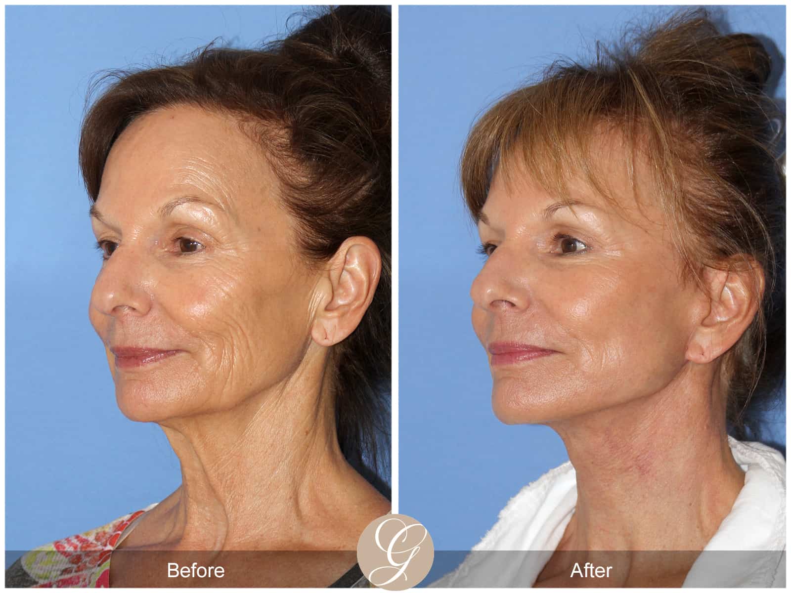 Neck Lift- 411 Image