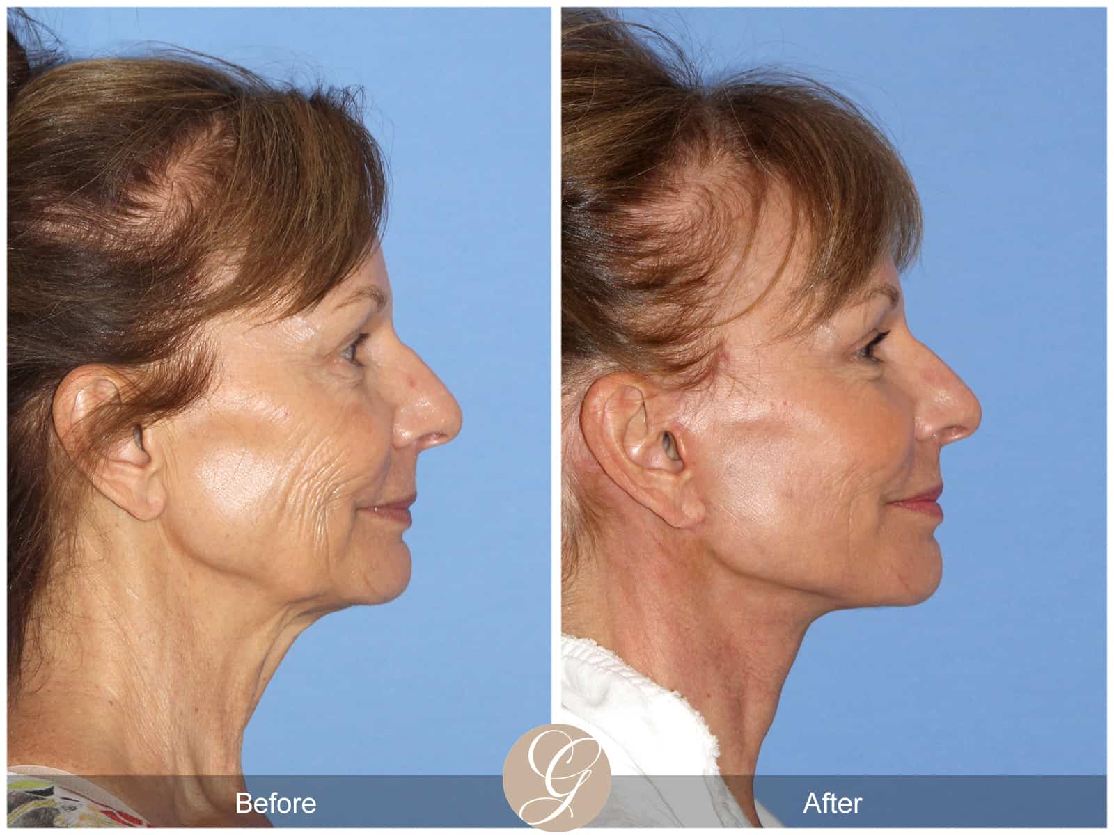 Neck Lift- 411 Image