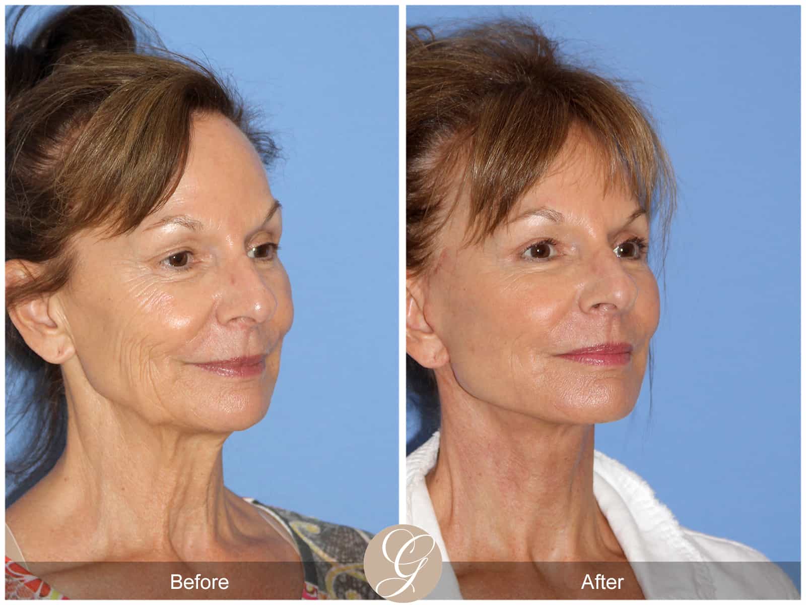 Neck Lift- 411 Image