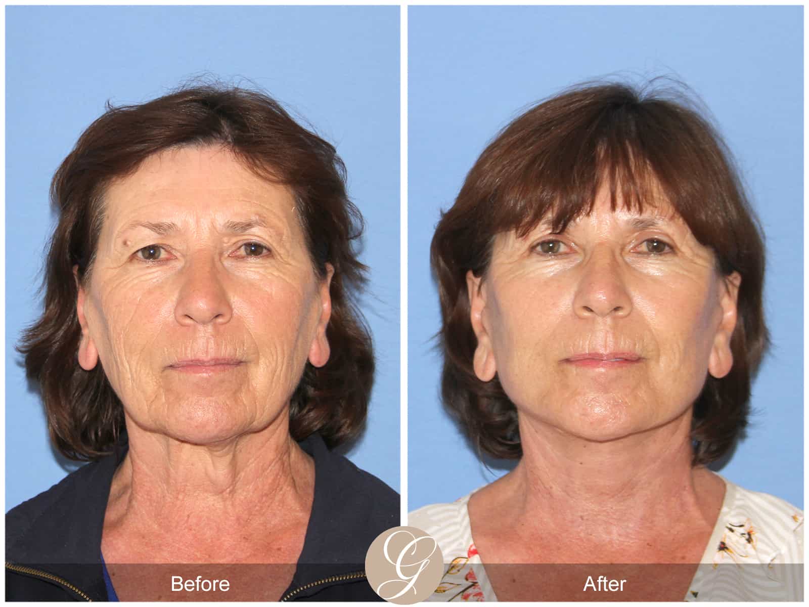 Neck Lift- 410 Image